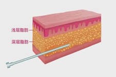 贵阳脂肪填充要选择哪家医院比较好?脂肪填充价格是多少