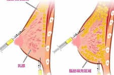 贵阳哪个医院做脂肪隆胸比较好?利美康美莱技术好又靠谱