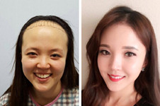 秃头女孩福音:韩国毛杰琳医院发际线植发效果了解一下！