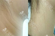颈部除皱手术效果图公开！韩国kidari与labom拉本医院有何不同