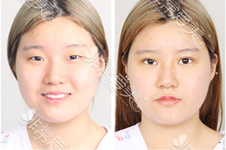 韩国K整形医院眼鼻手术多少钱？在韩国口碑优秀吗？