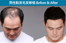 韩国植发经历分享，告诉你植发恢复需要注意的几个细节