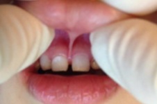 唇系带手术是啥有什么后遗症?会影响牙齿正畸效果吗?