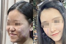 韩国下颌角磨骨哪家好?韩国下颌角保留二次角是新型术式吗
