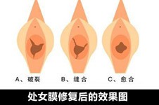 处修手术值得做吗?听说成功率很低是不是白花钱了?