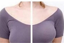 假体隆胸一边高一边低怎么办?韩国隆胸修复手术医生能做吗!