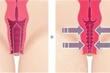 绵阳哪里可以做缩阴手术?据说当地集美都会来面诊这几家!