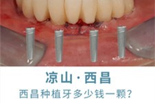 凉山西昌种植牙多少钱一颗,对比2021西昌种植牙价格便宜吗?