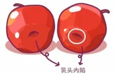 成都乳头内陷矫正手术费用公布,附成都乳头内陷治疗医院!