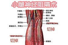 先别着急问成都小腿神经阻断术医院有哪几家?危害你知道吗!