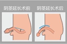 四川增大增长手术多少钱,增粗哪家医院好?个人经历分享!