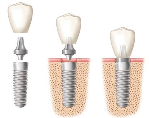 看完成都#2Y*&x*b口腔种植牙价格表,种植牙竟然2000起好便宜!