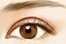 肿眼泡适合什么双眼皮手术?全切-三点-埋线均有利与弊!