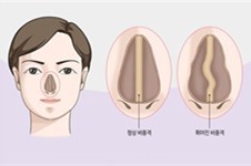 韩国芭堂隆鼻修复怎么样?通过真实患者的自述来了解!