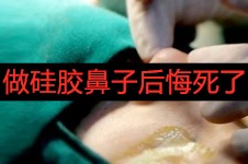 做硅胶鼻子后悔死了,两次花费75000修复硅胶鼻建议慎重考虑!