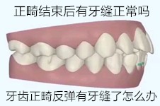 正畸結(jié)束后有牙縫正常嗎?細(xì)說牙齒正畸反彈有牙縫了怎么辦!