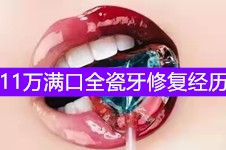 滿口全瓷牙死的心都有!網(wǎng)友公開花11萬滿口全瓷牙修復(fù)經(jīng)歷!