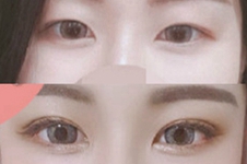 韩国POP整形医院埋线双眼皮+提肌+开内眼角术后效果反馈！