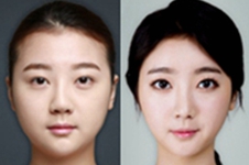 韩国面部吸脂医院：芙莱思、贝缇莱茵、爱她各有什么特色?
