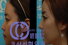 韩国碧夏整形医院肋软骨隆鼻效果怎么样？
