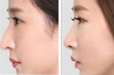 想要丑鼻成功“渡劫”，韩国欧佩拉和NANO整形鼻修复选哪家?