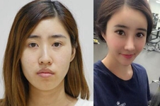 在韩国id医院做双鄂手术后，终于感受到女王的优越感！