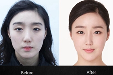 分享我在韩国必当归做耳软骨隆鼻+面部脂肪填充图片,超后悔