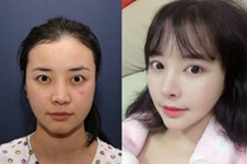 韩国鼻修复医院：秀美颜,NANO,欧佩拉,歌柔飞各有什么特色？