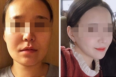 面部吸脂or瘦脸针如何选择?韩国明星线和迪美丽医院告诉你!