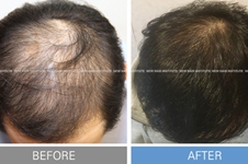 想做毛发移植害怕成活率低?江南NHI医院技术优势值得一看！