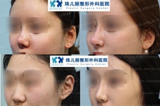 请看案例了解广州曙光王旭明和珠儿丽尹容逸隆鼻技术差异
