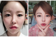 韩国VG百利酷改脸型技术怎么样？这有真人实例可参考