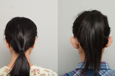 韩国普罗菲耳贴发耳手术真实过程分享,矫正后脸确实变小了