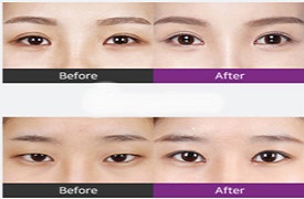  埋线双眼皮恢复期能正常工作吗?韩国必妩自然双眼神奇之处
