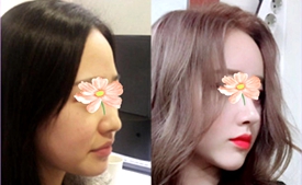韩国丽丝塔钻石鼻部整形好不?耳软骨和肋软骨隆鼻优势解析!