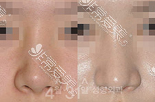 隆鼻假体歪了多久可以修复，韩国鼻修复哪家医院好？