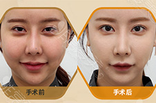 面部脂肪填充失败脸很假，韩国芙莱思面部填充修复靠谱吗