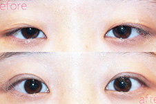 韩国BIO洪星杓：双眼皮手术不能完全改善先天性上眼皮下垂