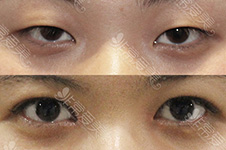 开外眼角出现粘连怎么修复，多位医生解密韩国开眼角技术