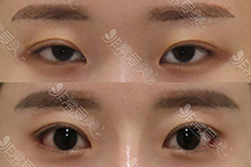 韩国美容整形高手18人之一的崔宰源不开眼角眼睛可以变大？