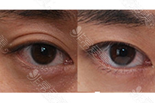 割完双眼皮离眉毛太近怎么办？怎么改善眉眼距离过近？