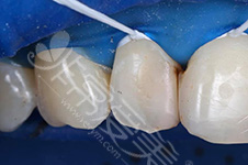 强迫症患者的补牙经历分享,医生补牙技术好直接决定颜值!