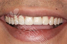 牙齿大部分缺失、全口都没牙了应该怎样镶牙更划算?