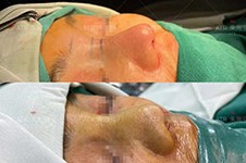 南京鼻修复专家挛缩鼻修复案例分享!都是代表性案例!