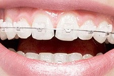 合肥牙齿矫正价格多少钱?牙友分享合肥整牙需要多少钱!