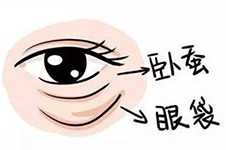 杭州祛眼袋手术哪家好?细数整友推荐医院和手术价格!