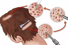 杭州哪家植发机构技术好?几大正规植发品牌各有千秋!
