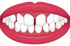 昆明牙齿矫正多少钱?有哪些矫正好的医院能推荐一下不?
