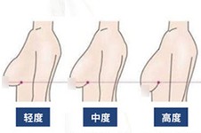 坐标北京,胸下垂去哪里治疗提升比较好?这几家都有特色!