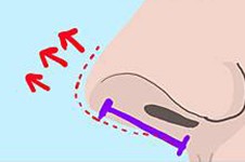 线雕鼻有哪些危害和后遗症?看完你还想做线雕隆鼻怪我!